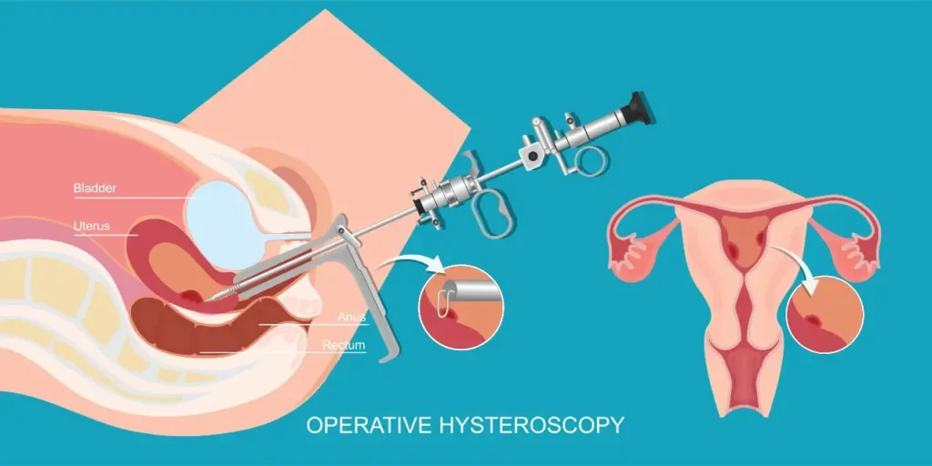 כיצד מתבצעת בדיקת היסטרוסקופיה see and treat