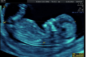 שקיפות עורפית תאומים